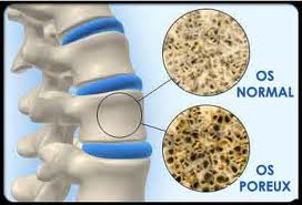 images-osteoporose.jpg